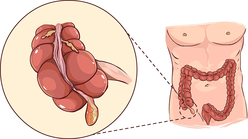 Appendix anatomy illustration
