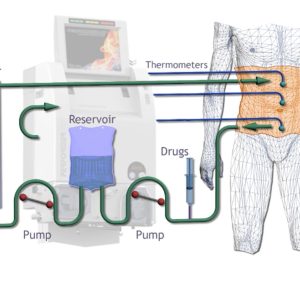 cytoreductive surgery and HIPEC treatment in Chennai by Dr Srikarthik Voleti